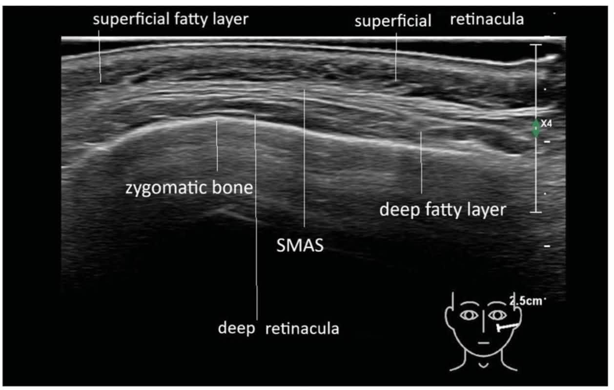 Superficial fatty layer、SMAS、deep fatty layer 與 Retinacula 超音波層次
